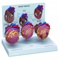 Heart Disease Mini Model Set